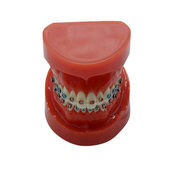 UM-B16 Studien modell mit festen Zahnspangen auf Zähnen (normal)