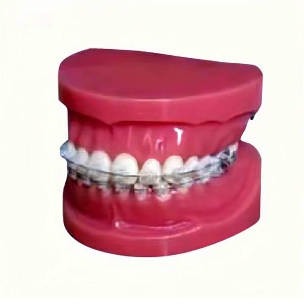 UM-B17 Studien modell mit festen Zahnspangen auf Zähnen (normal)