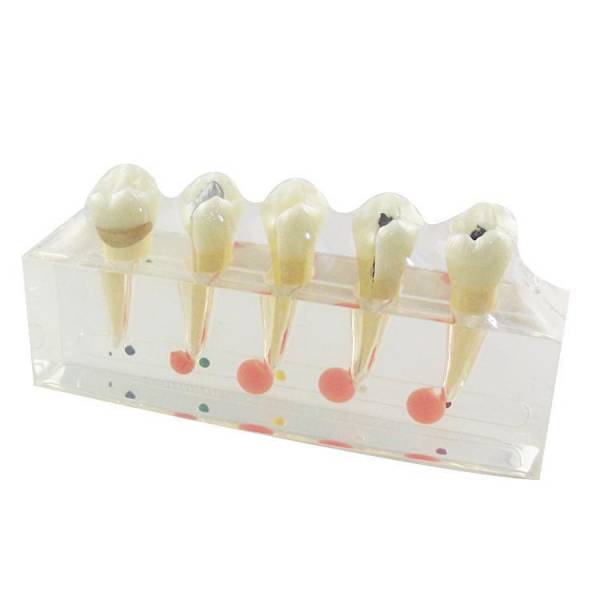 UM-L3A klinisches Modell der Zahn-und Zellstoff erkrankung