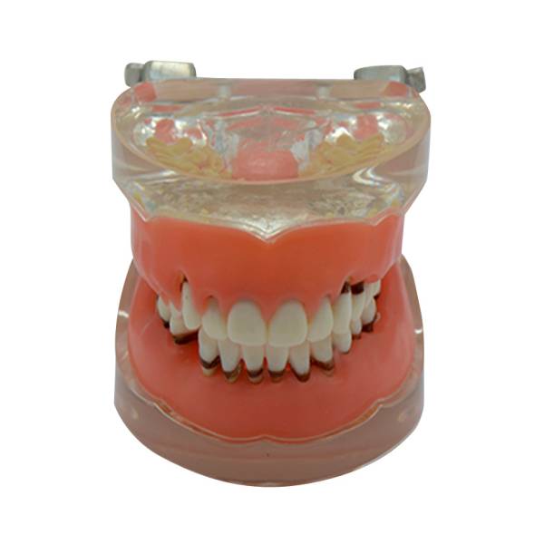 UM-S9 Modell der Zahnfleisch erkrankung